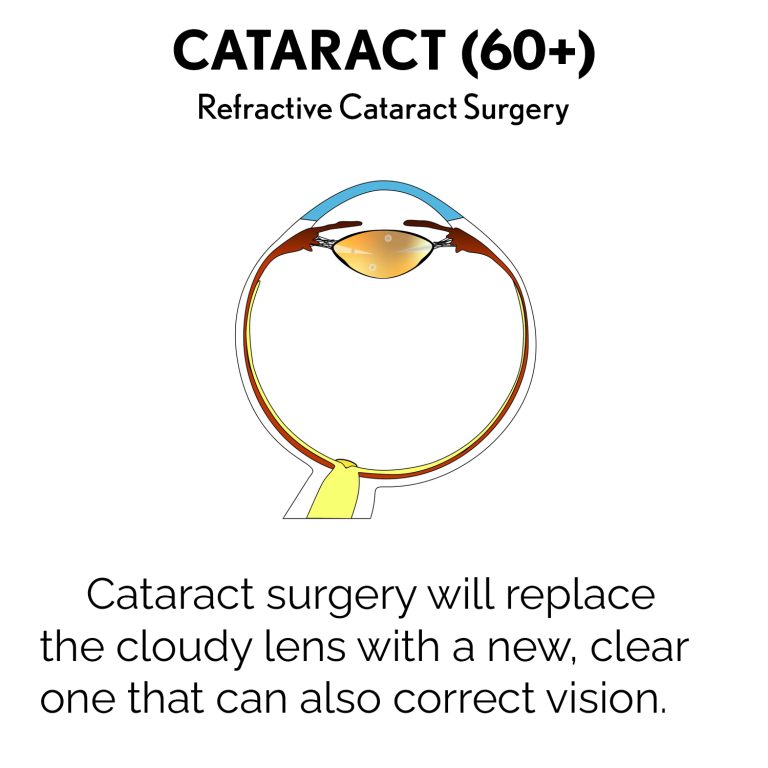Cataract